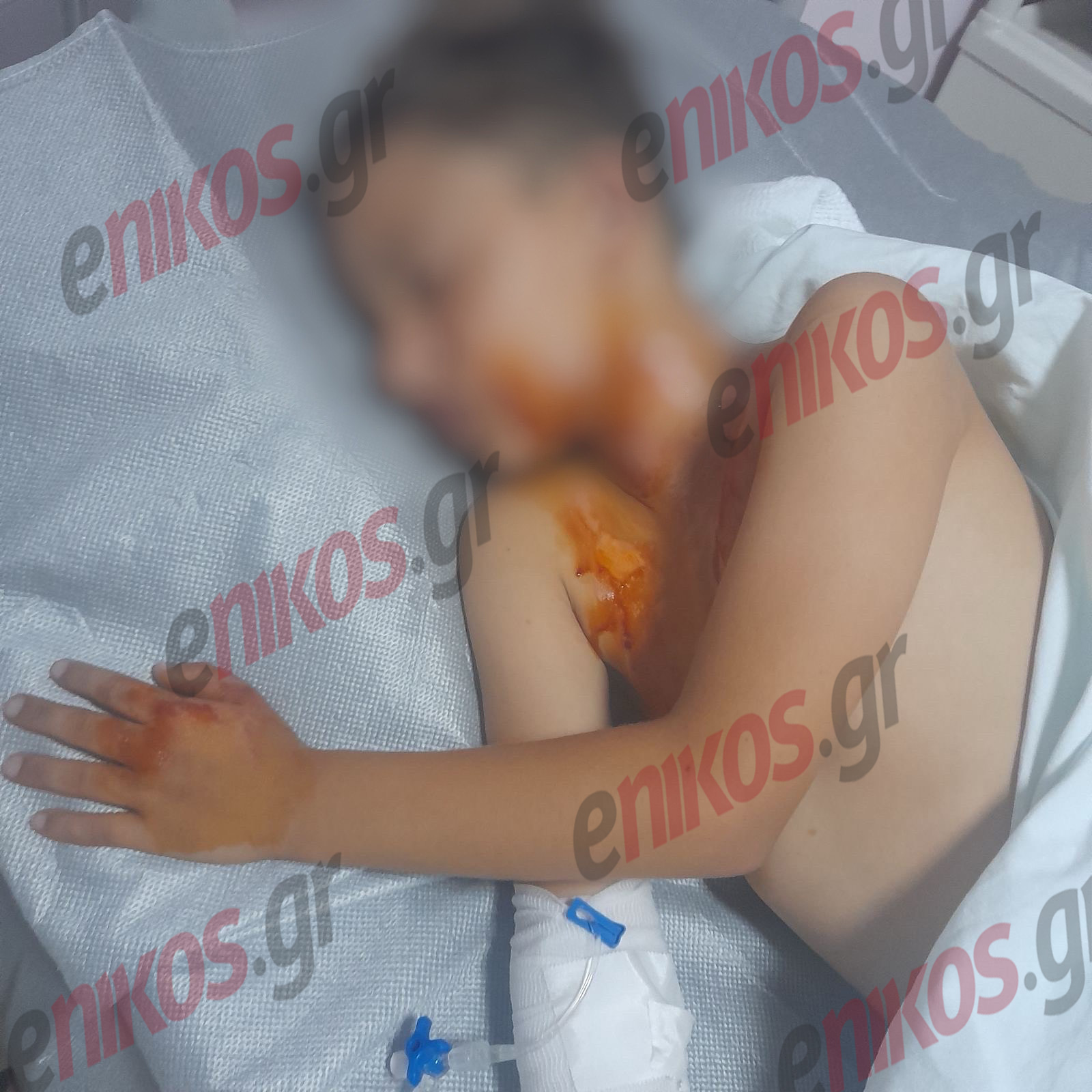 Πάτρα Βεγγαλικά Τραυματισμός