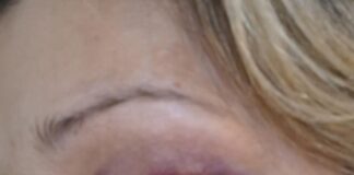 «Θα το ξαναέκανα και με μωβ μάτι»